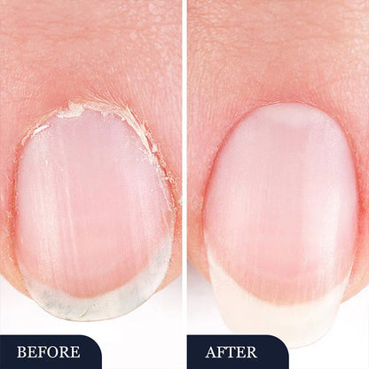2 In 1 Nail Fungus Repair Pen